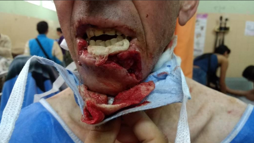 ¡ASESINOS! Casi degollado por una Guaya camino a su casa en Mérida (+Fotos) 3 guaya